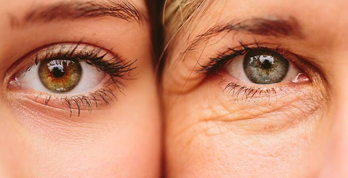 अलग-अलग उम्र की दो महिलाओं में आंखों के आसपास की त्वचा की उम्र बढ़ने के बाहरी लक्षण